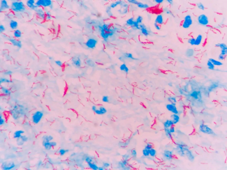 Immagine TUBERCOLOSI E MICOBATTERIOSI ANIMALI E UMANE: DIAGNOSI, SORVEGLIANZA E PREVENZIONE  